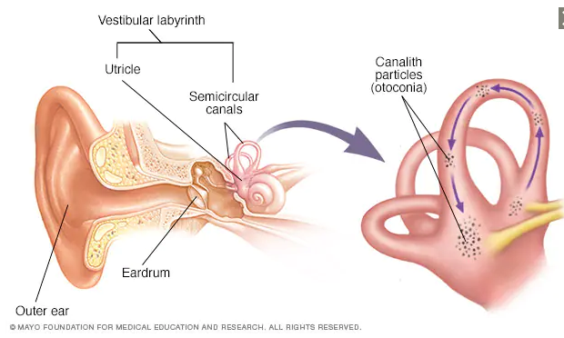 Pregnancy and Benign Paroxysmal Positional Vertigo (BPPV) - The Pulse