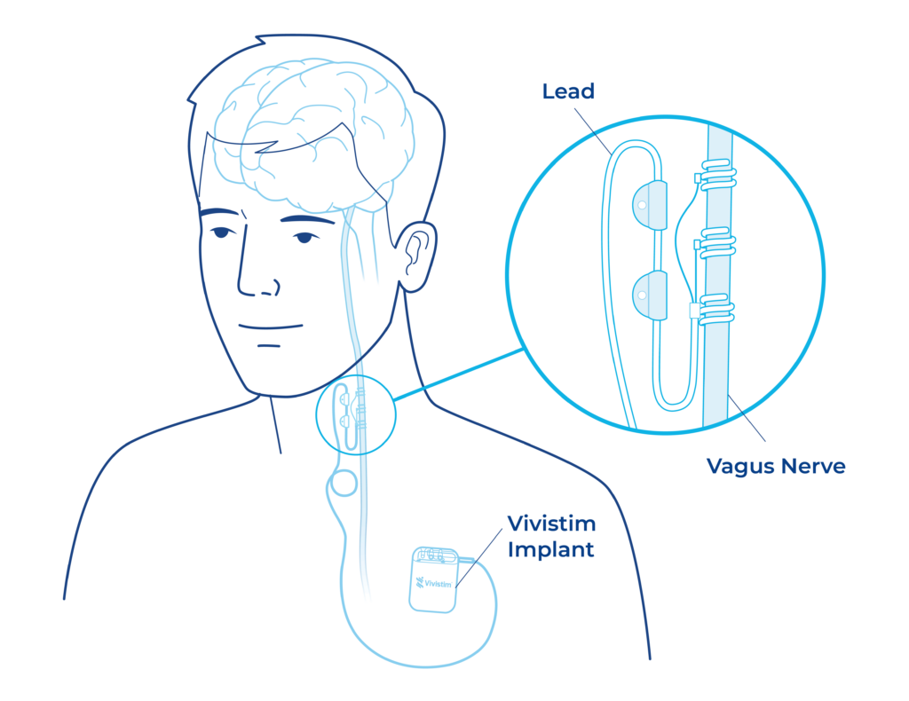 Vivistim Therapy at Brooks Rehabilitation