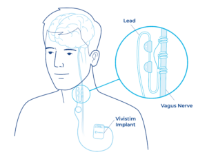 diagram of the implanted transponder shows that the transponder is implanted at the shoulder area and that a cord runs up to attach to the vagus nerve that leads to the brain. 